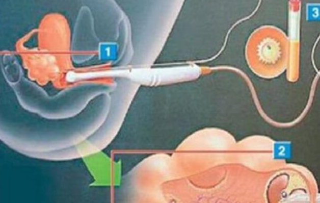 杭州试管婴儿体外受精过程详解