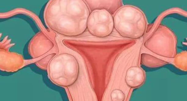 子宫腺肌瘤能否到泰国做试管婴儿？