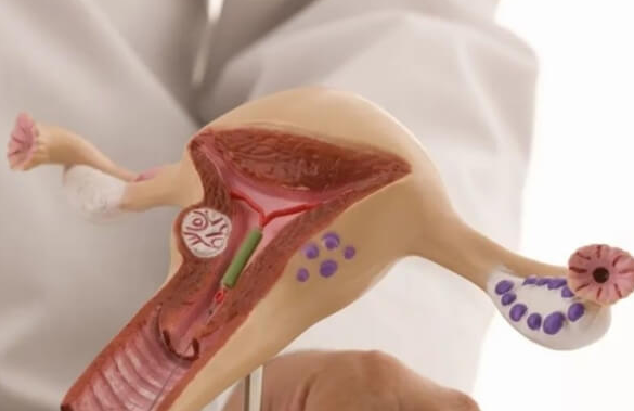 盆腔结核患者：试管婴儿之路，希望与挑战并存