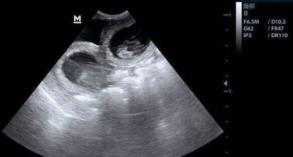 试管婴儿诊疗中B超与抽血检查：解码卵巢储备功能的“生命密码”