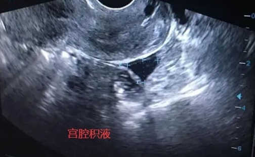 试管婴儿易发宫腔积液：激素水平改变或是主因