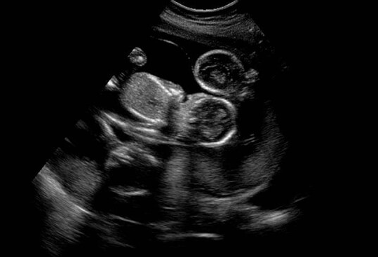 假性怀孕也有早孕反应？四大信号教你辨真伪