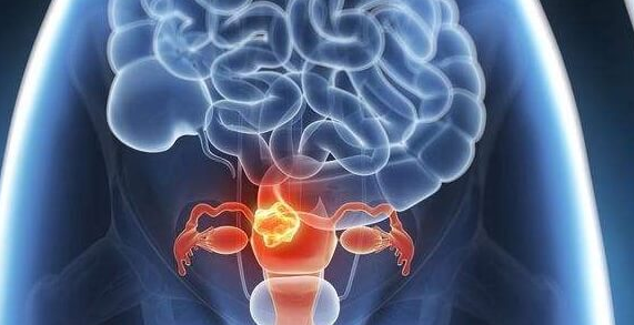 格鲁吉亚Universe：多囊适合人工授精还是试管婴儿？需从三方面考量