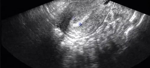 月经第4天检查出子宫内膜C类什么意思？