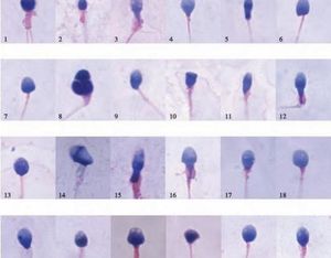 3分钟解读，畸形精子症是什么病异常精子跟它的区别