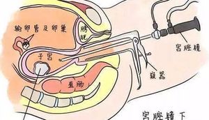 宫腔镜手术长什么样？术后要注意什么？ ​