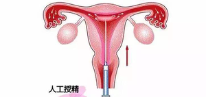 供精人工授精等待短则1周,长则数月?这3个原因让你