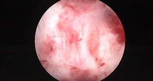 宫腔粘连做试管婴儿提前了解这5点,让好孕变容易