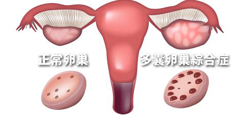 好“孕”妙招!多囊卵巢备孕这4种情况下要做试管婴儿