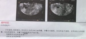 怀孕前3个月b超单上有哪个数字一般怀的是女孩？