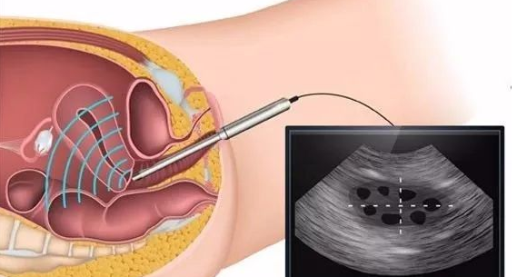 检查次数多害怕影响胎儿，关于阴道B超你知多少？
