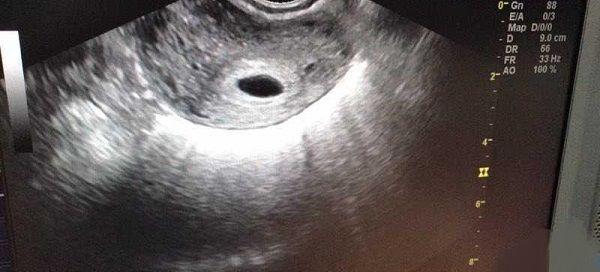怀孕出现空囊保胎的情况，有可能成功经验吗?