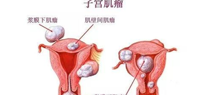 民间偏方大葱叶治子宫肌瘤是骗局吗?