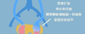 男言之隐:一文带你全面了解男性精索静脉曲张手术的利弊
