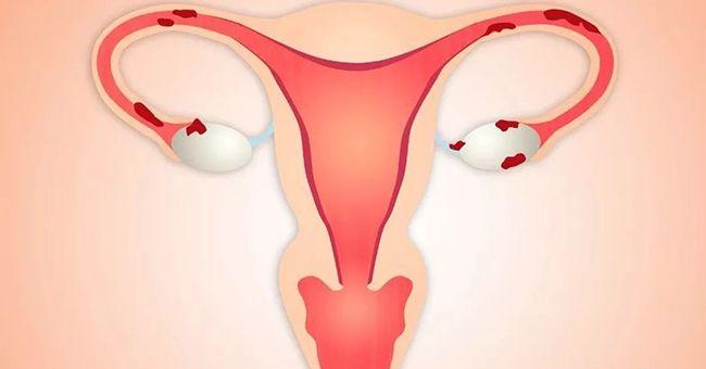 面对子宫内膜异位症，有3种解决方案