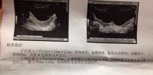 可怕!吃达英35胖20斤 更多副作用科普