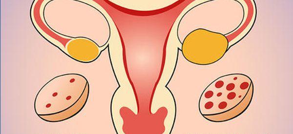 多囊卵巢做第几代试管婴儿成功率最高？