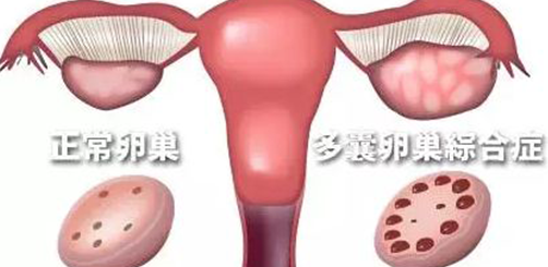 多囊卵巢综合征治疗6年未果，需要做试管婴儿怀孕吗？