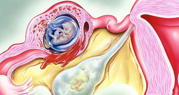 人工授精也会宫外孕2%-8%的概率,如何避免知道