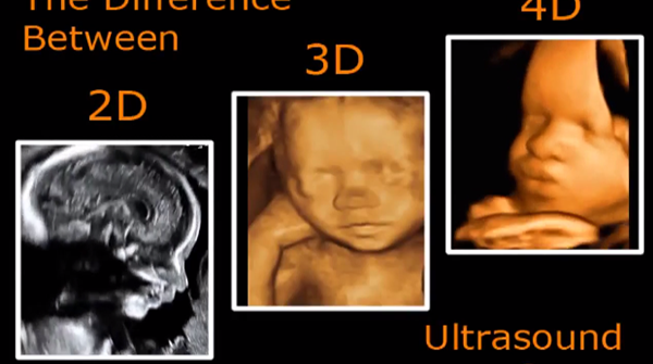 孕期做二维和三维彩超的区别很明显，清晰度相差不止一点