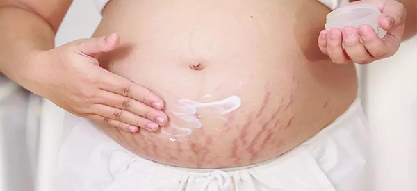 孕30周用袋鼠妈妈或者帕玛氏橄榄油去除妊娠纹管用吗？