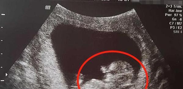 14周胎儿大小标准主要看头围还是身长?