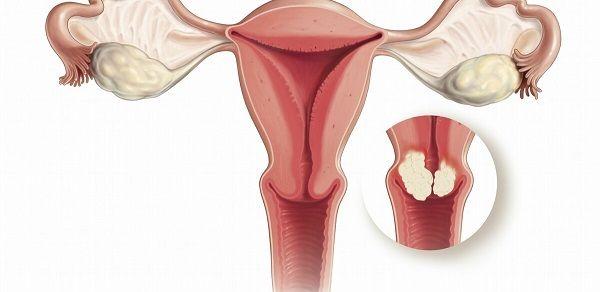 孕期宫颈管扩张有什么危害？