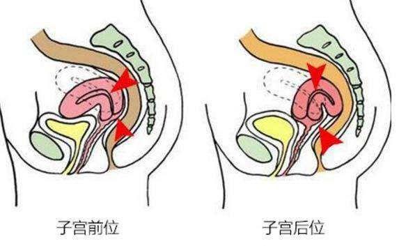 子宫后位时采用后入式的体位会更容易怀孕吗?