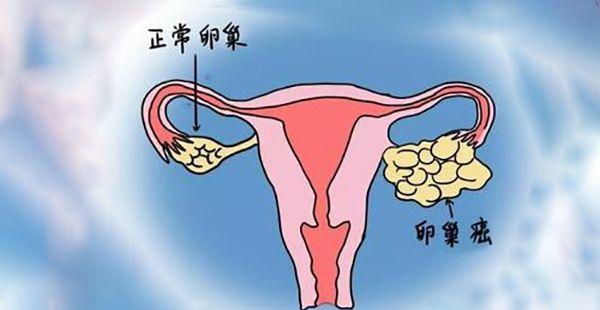 卵巢囊肿手术会不会影响生育？术后怀孕几率是多少？