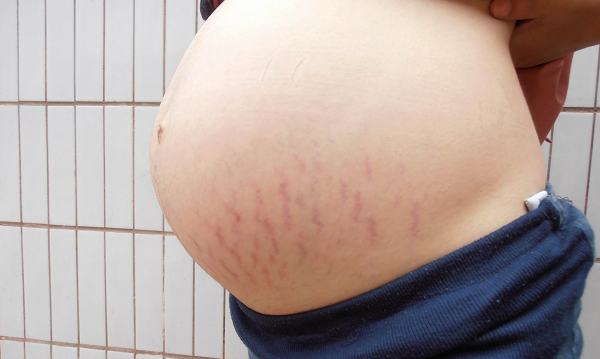 产科医生透露孕妇长妊辰纹时间，科学防与治掌握这5点