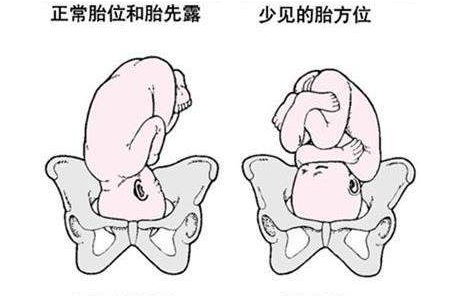 胎位不正的孕妇选择桥式卧位好还是膝胸卧位？