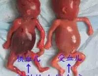 试管婴儿双胞胎-从怀孕到出生，都经历了什么？