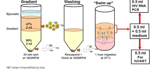 hiv病毒感染者做精子洗涤技术真的有用吗？