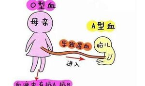 警惕abo溶血性黄疸，不注意可能酿成大祸