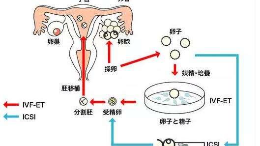 什么是体外受精？做试管婴儿非常重要的一个流程