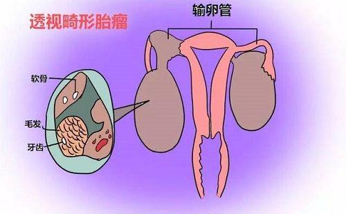 卵巢畸胎瘤形成后一般都是双侧吗？