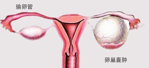 卵巢囊肿蒂扭转早期症状是一直持续性疼痛吗？