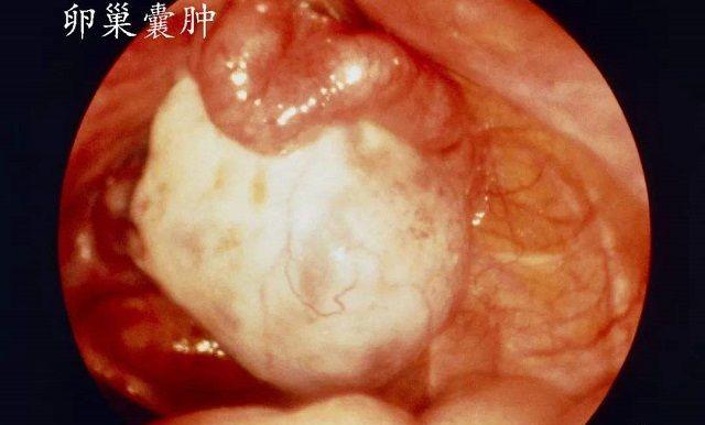 卵巢囊肿能怀孕吗？几率大吗？