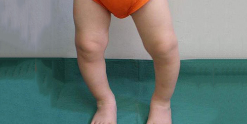 一岁半的宝宝是罗圈腿要如何矫正呢？