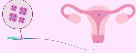 囊胚移植成功率不一定就最高!胚胎移植的3大方法解读