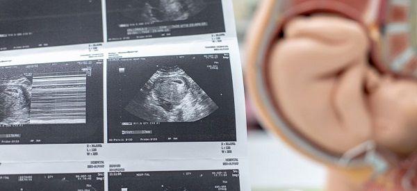 怀孕13周加1已生男宝宝的NT检查单子是什么样？