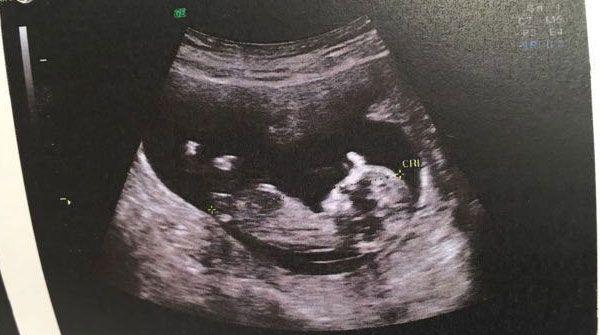 孕12周NT男宝特点，值1.6mm是男孩吗？