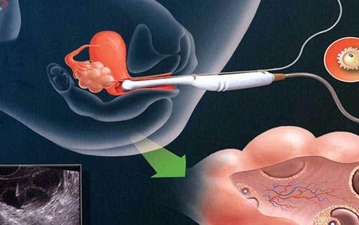 胚胎移植后应该注意什么，会影响试管婴儿成功率吗？