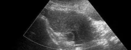盆腔有积液就是盆腔炎？影响试管婴儿移植成功率吗？