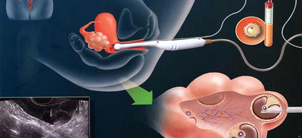 试管婴儿阴道取卵手术后常见的并发症有哪些？