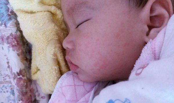 预防幼儿急疹有必要！宝宝出疹后哭闹不止有3个原因