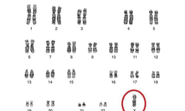 胎儿消失的性染色体：45XO，矮小、不孕难治疗