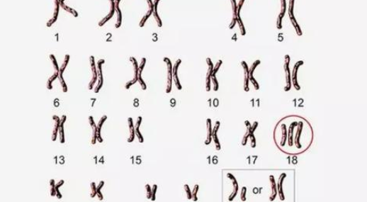 18号染色体和男女没关系，但发生异常会导致这些疾病