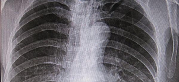 为什么做试管前必拍有辐射的X光胸片？