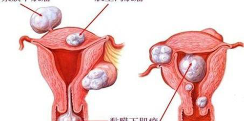 子宫肌瘤31岁未能自然生育，能否通过试管婴儿助孕生育？